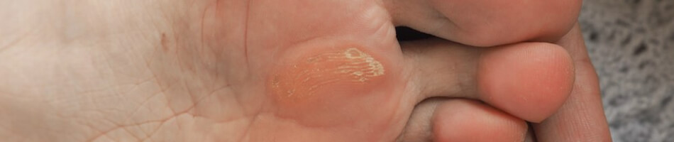 Zdjęcie nagniotków