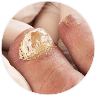 Paznokcie - grzybica paznokci