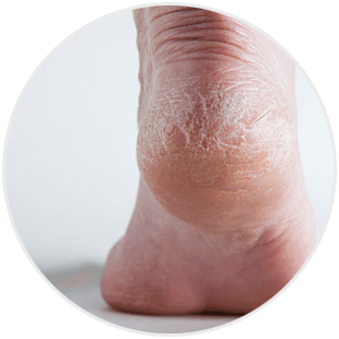 Rozpadliny na stopach